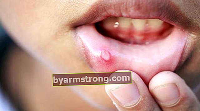 In quale sezione andare per le ferite intraorali? Quale medico dovrebbe essere fissato per l'herpes in bocca, AFT e verruche?