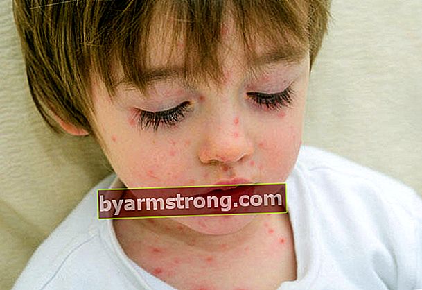 Quali sono i sintomi della varicella? (Trattamento contro la varicella)