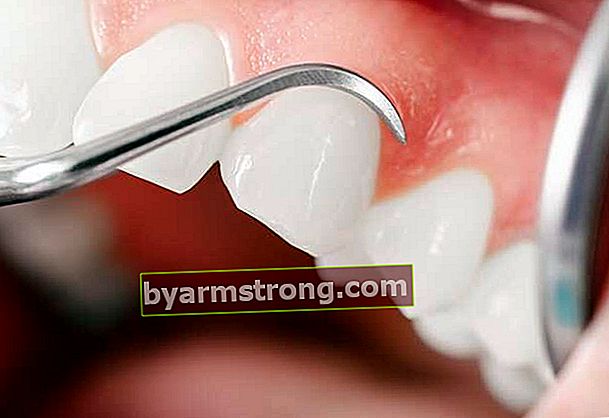 歯周病は、このタイプの癌によって引き起こされる可能性があります。