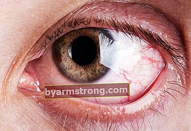 Qual è la causa del rossore agli occhi?