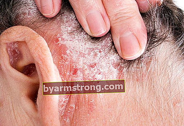 Sbarazzati dell'eczema che appare sul cuoio capelluto