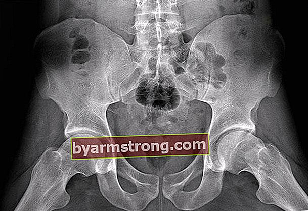 엉덩이 충돌 증후군이란 무엇입니까?