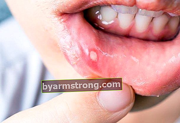Cosa sono le ulcere della bocca?