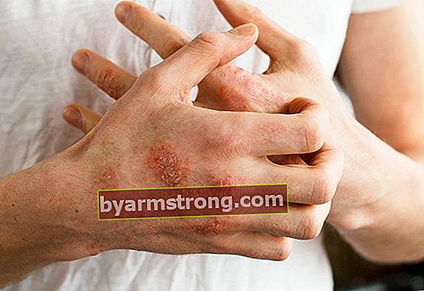 Quali sono le cause dell'eczema?